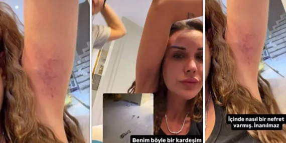 Polat Ailesinde Kardeş Kavgası Kanlı Bitti! Dilan Polat Yolunmuş Saçlarını Paylaştı: "Sıla Beni Darp Etti!"