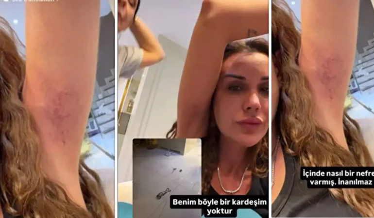 Polat Ailesinde Kardeş Kavgası Kanlı Bitti! Dilan Polat Yolunmuş Saçlarını Paylaştı: "Sıla Beni Darp Etti!"