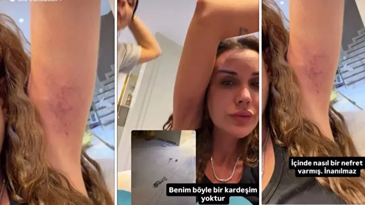 Polat Ailesinde Kardeş Kavgası Kanlı Bitti! Dilan Polat Yolunmuş Saçlarını Paylaştı: "Sıla Beni Darp Etti!"